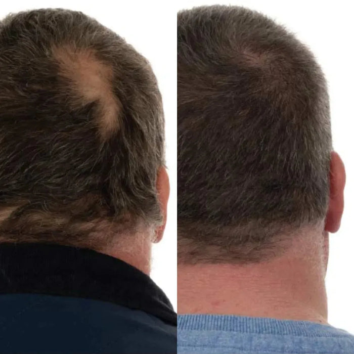 Foligain lotion men (10% Trioxidil) - Hairgivers